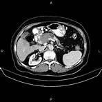 adenocarcinoma gástrico tipo intestinal2