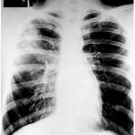 tuberculose pleural imagens5