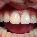 人工植牙後遺症4