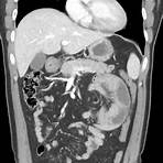 small bowel obstruction internal hernia radiology4