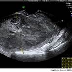 miomatosis uterina clasificación3