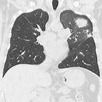 Tromboembolismo pulmonar wikipedia4