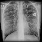 shrinking lung syndrome5