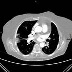 Tromboembolismo pulmonar wikipedia3