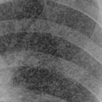 Tuberculosis wikipedia4