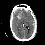tomografía computarizada cerebral tce3