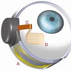 artificial eye wiki3