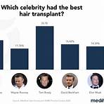 celebrity hair transplant before and after3