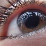 ponto branco na iris olho3