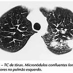tuberculose pleural imagens3