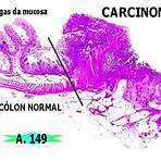 adenocarcinoma de cólon anatpat1