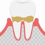 牙周病治療方法 健保3