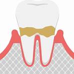 牙周病治療方法 健保4