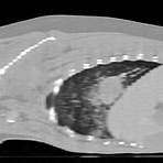 adenocarcinoma pulmão cão raio x3