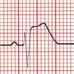 infarto agudo do miocárdio ecg4