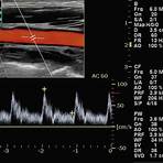 spectral analysis ultrasound4