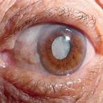 ponto branco na iris olho1
