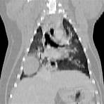 adenocarcinoma pulmão cão raio x4