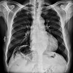 chilaiditi syndrome radiology3