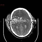 tomografía computarizada cerebral tce4