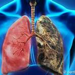 symptome einer lungenerkrankung3
