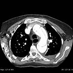 Aneurisma de aorta abdominal wikipedia3