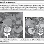 Aneurisma de aorta abdominal wikipedia3
