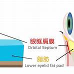 眼袋手術後遺症1