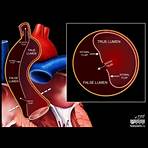 dissezione arco aortico3