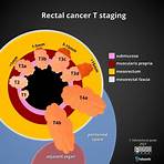 cancer de colon y recto1