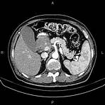 adenocarcinoma gástrico tipo intestinal5