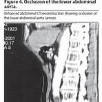 Aneurisma de aorta abdominal wikipedia1