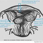 miomatosis uterina clasificación2