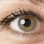 what is a person with central heterochromia in humans1