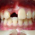 人工植牙後遺症1