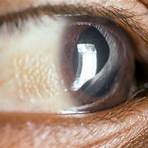 ponto branco na iris olho4