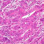 adenocarcinoma gástrico histologia4