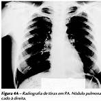 tuberculose pleural imagens2