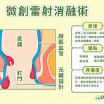 痔瘡手術過程3