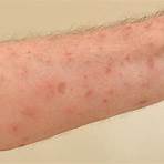 scabies symptoms rash pictures1