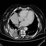 Tromboembolismo pulmonar wikipedia2