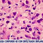 adenocarcinoma gástrico histologia3
