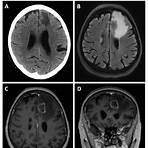 esquemic colorectal cancer and brain metastasis pdf4
