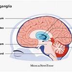 basal ganglia hemorrhage symptoms1