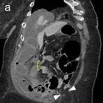 small bowel obstruction internal hernia radiology1