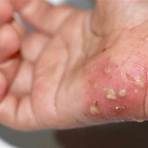 scabies symptoms rash pictures2