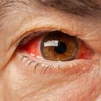 broken blood vessel in eye1