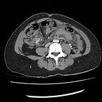 small bowel obstruction internal hernia radiology2