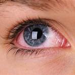 How long does it take to get rid of pink eye?3