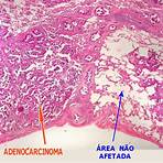 adenocarcinoma de cólon anatpat5